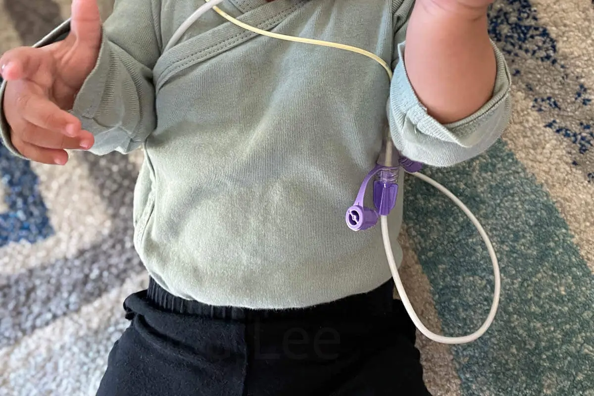NG Tube Woes How to Clear a Clogged Feeding Tube for Your Baby
