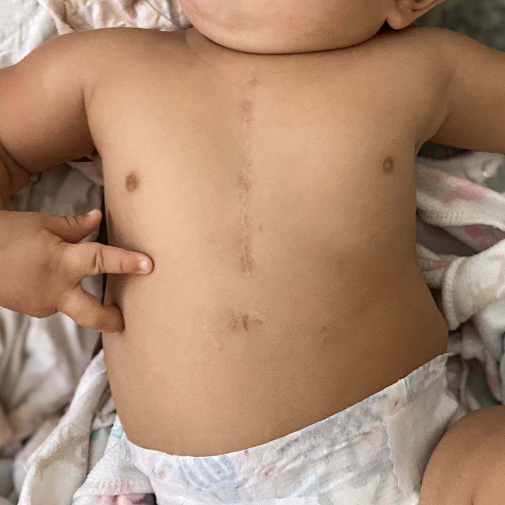 Open Heart Surgery Scars Your Baby’s Surprise Warrior Wounds