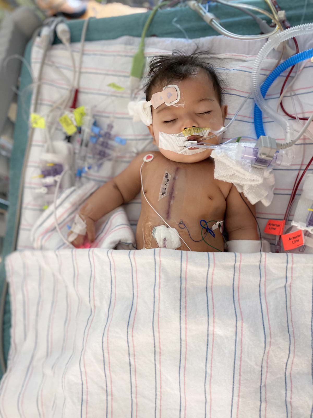 Lines and Tubes and Beeps, oh My!: A Baby After Open Heart Surgery